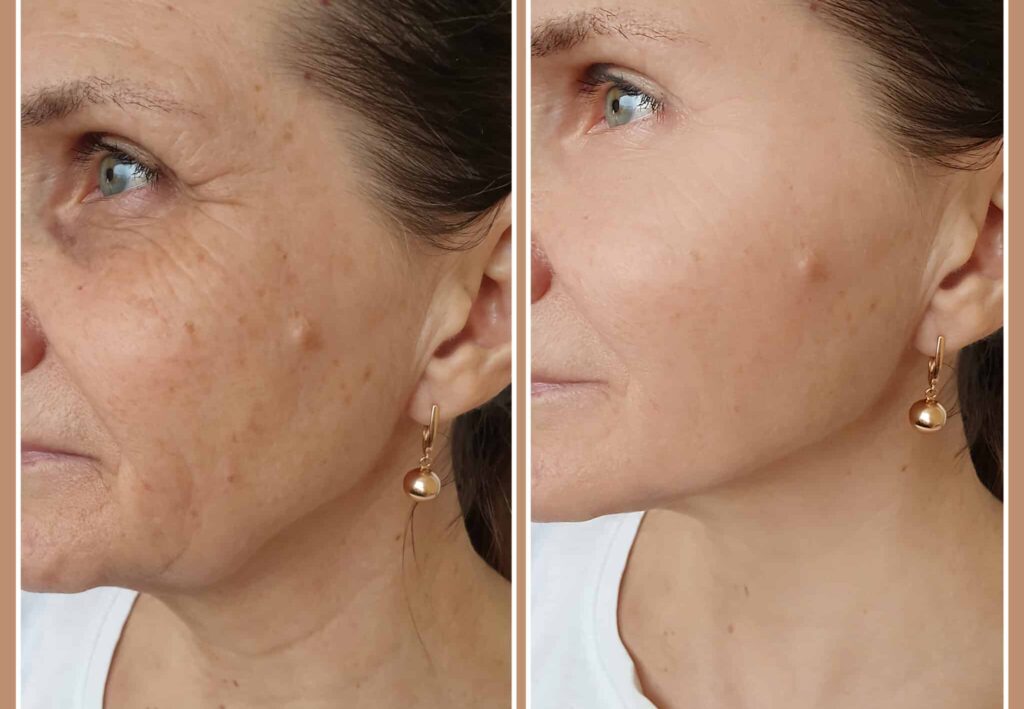 woman face wrinkles before and after esthetician skincare treatment